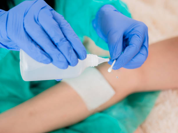 Hands of doctor in sterile gloves are going to be treated with antiseptic wound on the knee of a teenage girl. Providing first aid to a teenage girl who injured her leg. Close-up of the doctor's hands treating an abrasion on the patient's knee with a disinfectant. antiseptic stock pictures, royalty-free photos & images