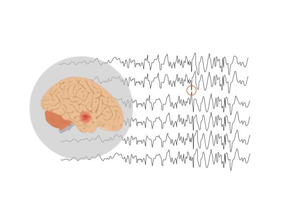 illustrazioni stock, clip art, cartoni animati e icone di tendenza di concetti di epilessia del lobo temporale - eeg epilepsy science electrode