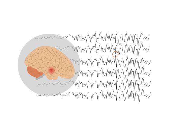 ilustrações de stock, clip art, desenhos animados e ícones de concepts of temporal lobe epilepsy - eeg epilepsy science electrode