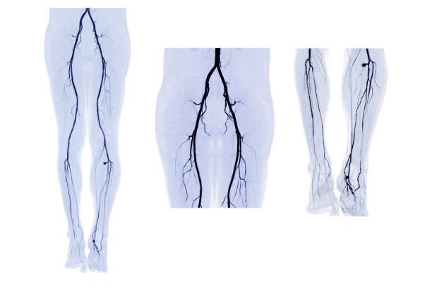 collezione di arteria femorale cta che scappa dall'immagine mip 3d. - human limb foto e immagini stock