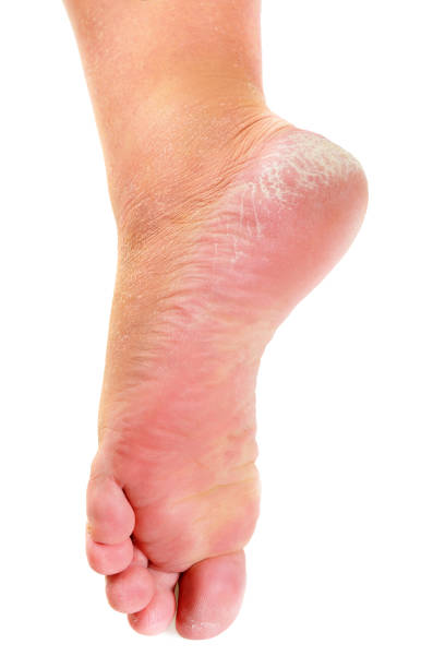 pie con hongos primer plano - podiatrist pedicure human foot healthy lifestyle fotografías e imágenes de stock