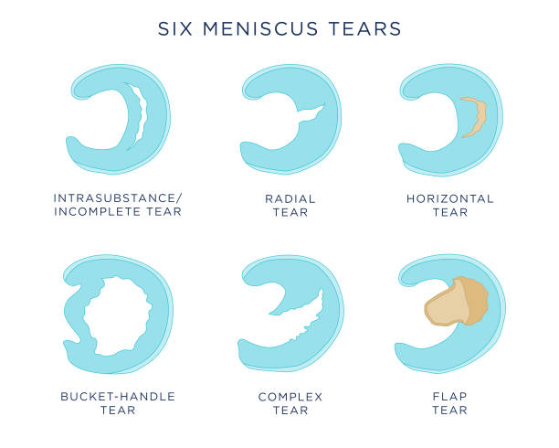 Meniscus tears Flat vector illustration showing six different types of (knee) meniscus tears, including intrasubstance tear, radial tear, horizontal tear, bucket-handle tear, complex tear, and flap tear. fibula stock illustrations