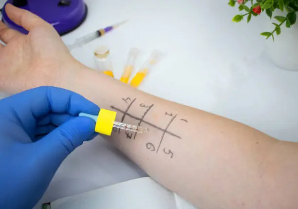 Photo of An allergist doctor in the laboratory conducts a prik allergy test. Skin test for household, food, epidermal allergic reactions