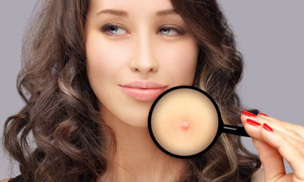 istock Post-Acne Marks /Treating Acne Scars.Acne Scar Removal 1255571384