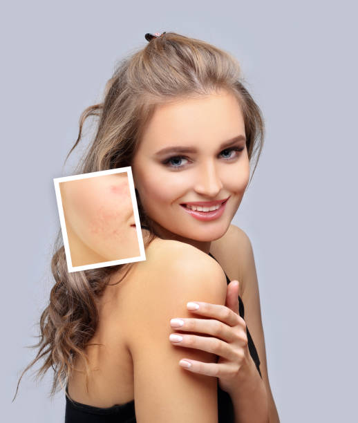 istock Post-Acne Marks /Treating Acne Scars.Acne Scar Removal 1255571943