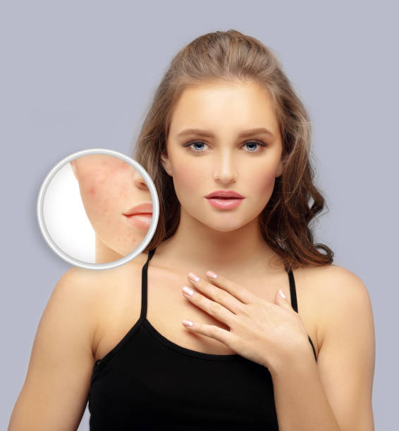 istock Post-Acne Marks /Treating Acne Scars.Acne Scar Removal 1255571945