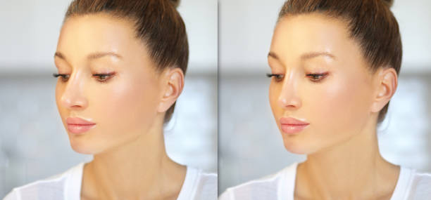 rhinoplasty.before and after. process of reconstructing nose - reconstructing imagens e fotografias de stock