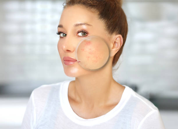 post-acne marken /behandlung akne narben.akne narbe entfernung - rosazea stock-fotos und bilder