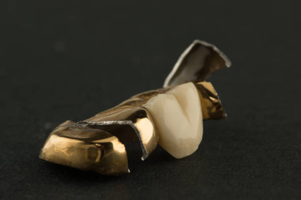 istock damaged stamped brazed dental bridge 1255725438