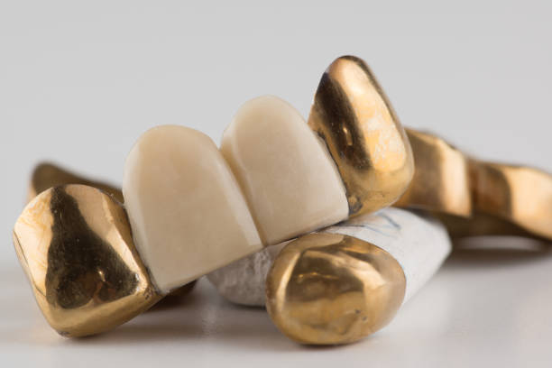 istock stamped brazed dental bridges 1255727258