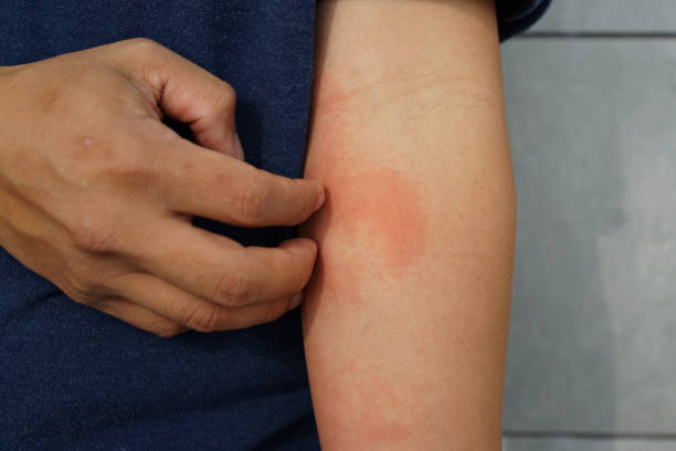 dermatitis alérgica de erupción eczema piel en el antebrazo del paciente. - itchy skin fotografías e imágenes de stock