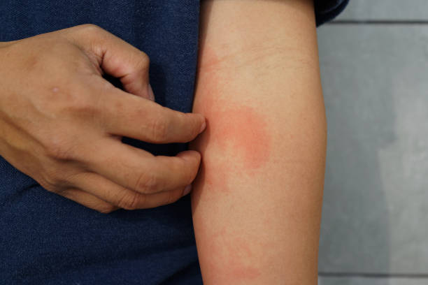 Allergic rash dermatitis eczema skin on forearm of patient. stock photo