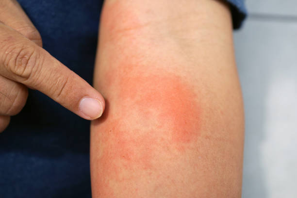 istock Allergic rash dermatitis eczema skin on forearm of patient. 1255739021