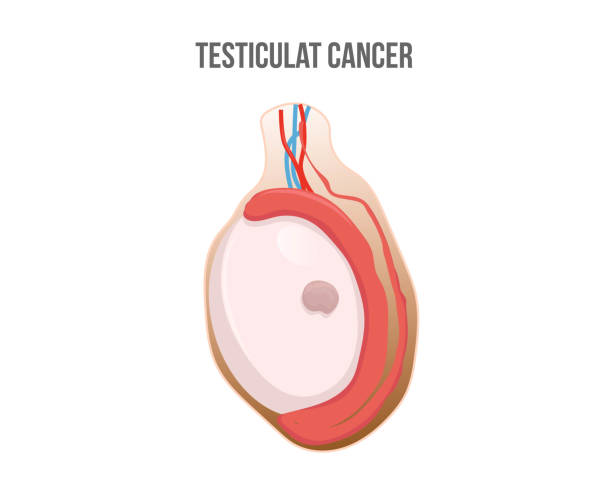 testículo con tumor