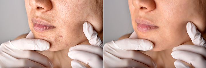Problemas de la piel y la cicatriz del acné, Antes y después del tratamiento del cuidado facial del acné, Concepto de belleza, Médico examen de la cara del paciente. photo