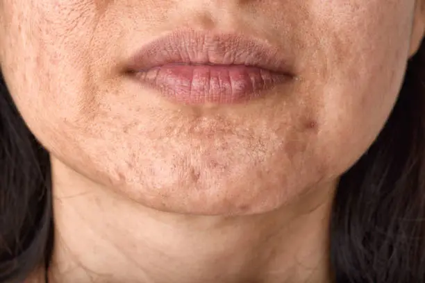 Skin problem with acne diseases, Close up woman face with whitehead pimples on chin, Menstruation breakout, Scar and oily greasy face, Beauty concept.