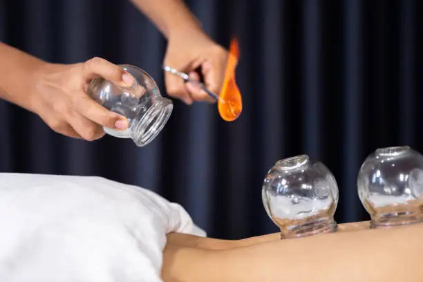 close up glass cup with fire for cupping treatment on female back