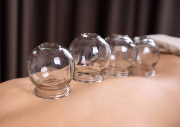 young woman receiving cupping treatment on back