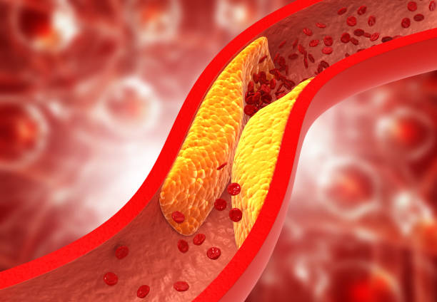 arterias obstruidas, placa de colesterol en la arteria - modo de vida no saludable fotografías e imágenes de stock