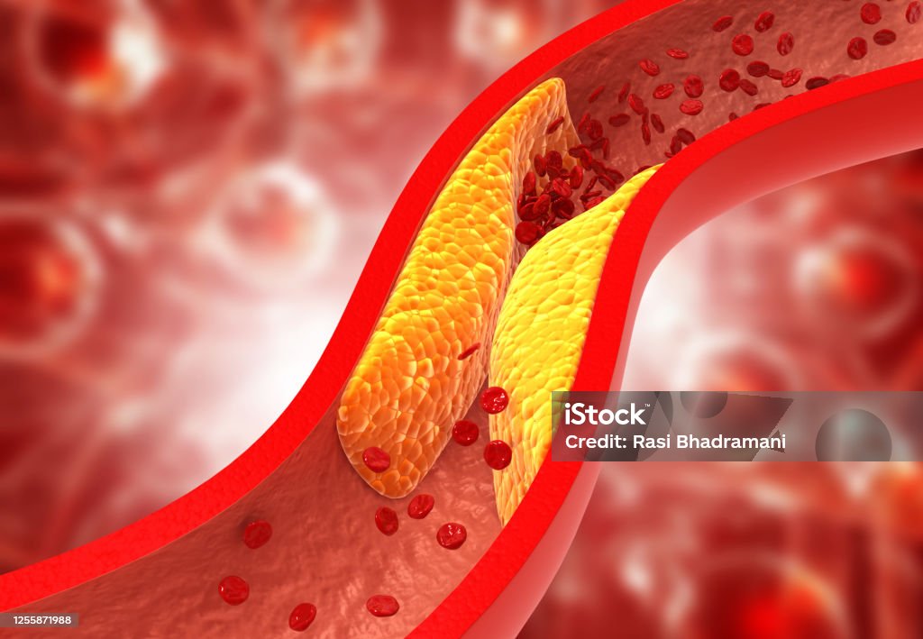 Clogged arteries, Cholesterol plaque in artery Clogged arteries, Cholesterol plaque in artery. 3d illustration Cholesterol Stock Photo