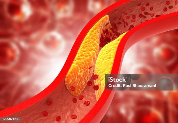 Clogged Arteries Cholesterol Plaque In Artery Stock Photo - Download Image Now - Cholesterol, Atherosclerosis, Artery