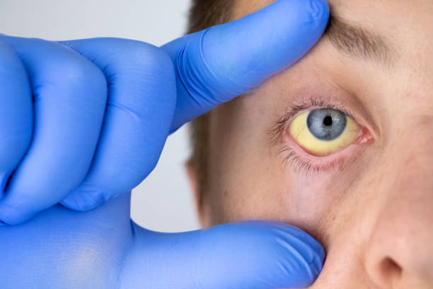 The yellow color of the male eye. Symptom of jaundice, hepatitis or problems with the gall bladder, gastrointestinal tract, liver. stock photo