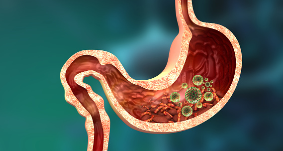 Gastritis is an inflammation of the inner lining of the stomach that causes intense pain, heartburn and burning. 3D illustration