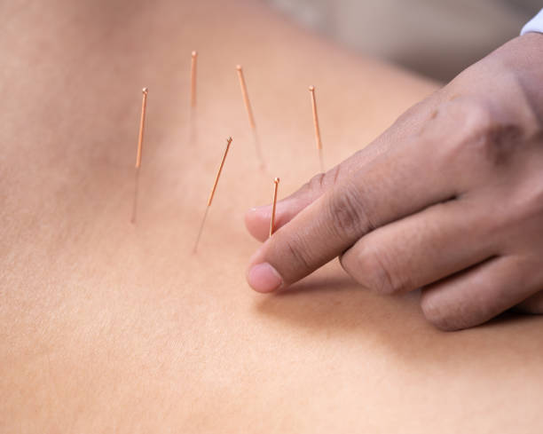 istock woman undergoing acupuncture treatment on back 1255916339
