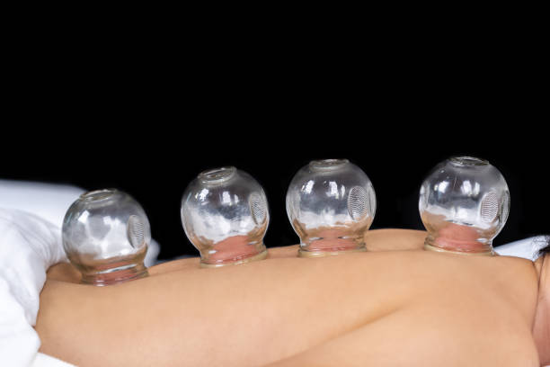 suction cup treatment on female back close up suction cup treatment on female back cupping therapy stock pictures, royalty-free photos & images