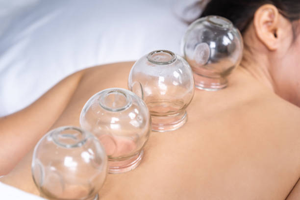 여자 수신 컵 치료 에 다시 - acupuncture cupping 뉴스 사진 이미지