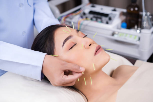 istock woman undergoing acupuncture treatment on face 1255920509