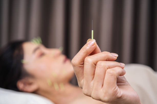 woman undergoing acupuncture treatment on face - acupuncturist imagens e fotografias de stock