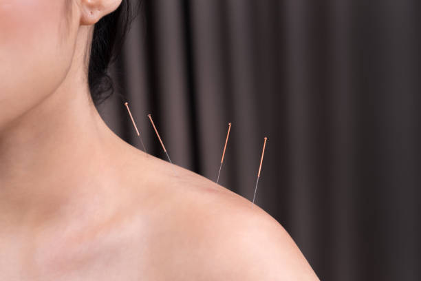 istock woman undergoing acupuncture treatment on shoulder 1255920546