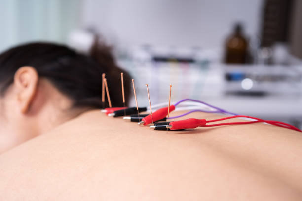 istock woman undergoing acupuncture treatment with electrical stimulator on back 1255920556