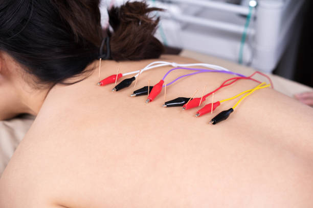 istock woman undergoing acupuncture treatment with electrical stimulator on back 1255920557