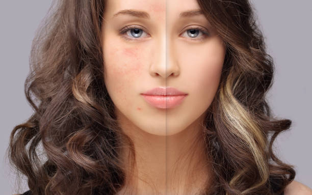 segni post-acne / trattamento delle cicatrici da acne.rimozione della cicatrice dell'acne - microdermabrasion foto e immagini stock