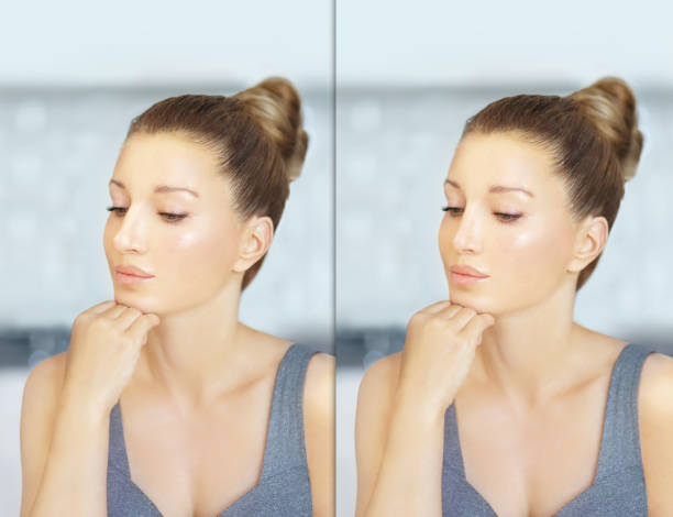 rhinoplasty.before and after. process of reconstructing nose - reconstructing imagens e fotografias de stock