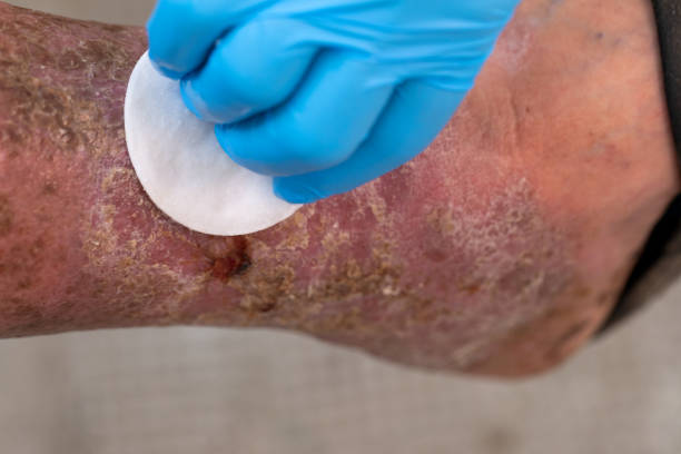 ulcera del piede - human foot diabetes ulcer senior adult foto e immagini stock