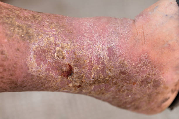 bérc - gangréna - stock snímky, obrázky a fotky