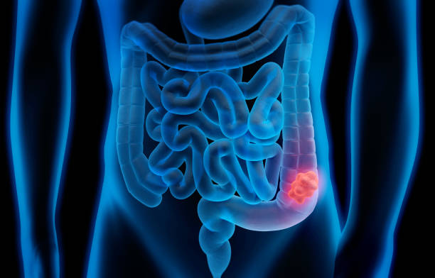 3d illustration of colon cancer - colon tumor - medical test imagens e fotografias de stock