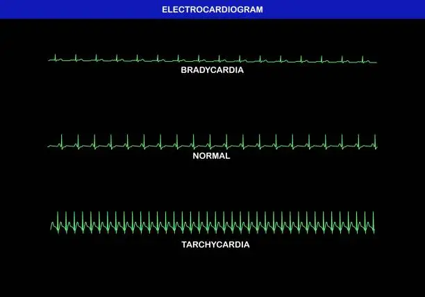 Vector illustration of Illustration of different heart rate on electrocardiogram.