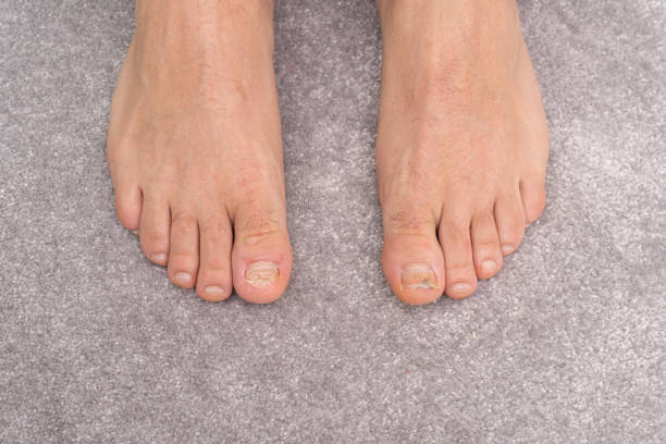 due piedi uomo, vista dall'alto. grandi dita con malattie delle unghie sulle gambe dell'uomo. tappeto grigio sullo sfondo. concetto di cosmetologia. - men naked water male foto e immagini stock