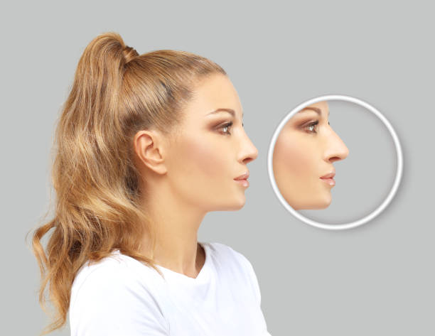 istock Rhinoplasty.Before and after. process of reconstructing nose 1256673850