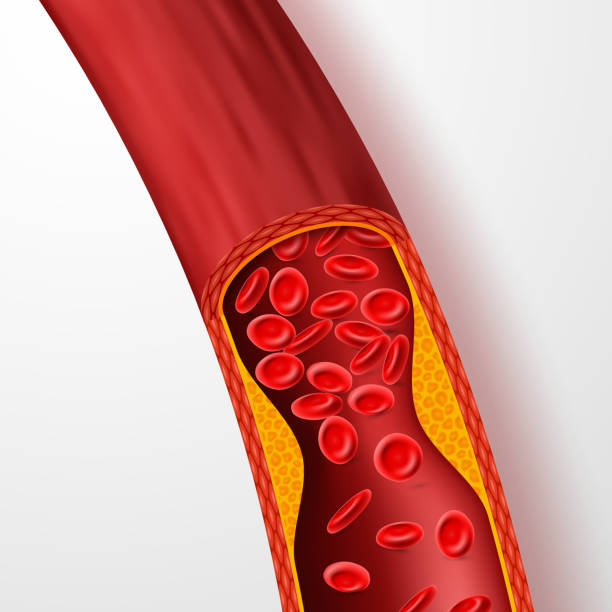 zablokowane naczynie krwionośne, tętnica z zakrzeplą cholesterolu. żyła 3d z ilustracją wektorową skrzepu - human artery cholesterol atherosclerosis human heart stock illustrations