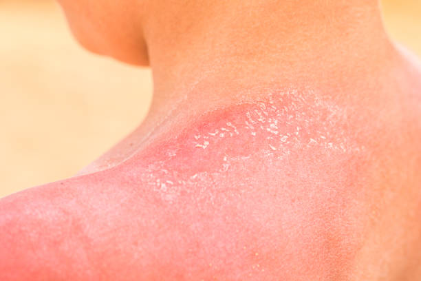 una spalla ravvicinata con la pelle bruciata dal sole rosso - wound sunburned scar physical injury foto e immagini stock