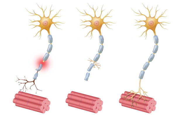 Peripheral Neuropathy illustration Neuroregeneration refers to the regrowth or repair of nervous tissues, cells or cell products. Peripheral Neuropathy illustration neuron axon stock illustrations