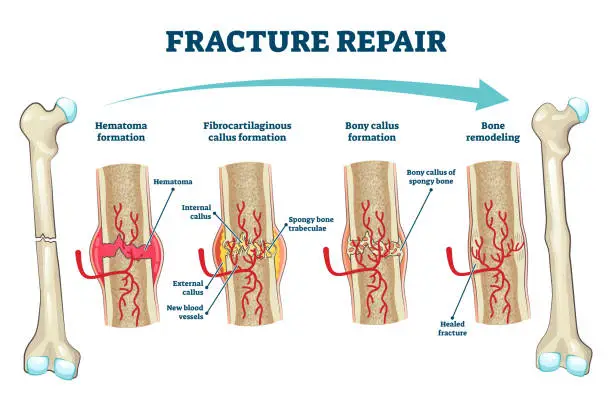 Vector illustration of Fracture repair as educational bone remodeling formation vector illustration