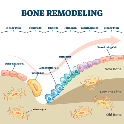 Bone remodeling process educational explanation with labeled structure scheme vector illustration. Skeleton growth closeup and formation stages with osteocyte, osteoclast or osteoblast example diagram