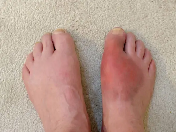 Swollen red foot caused by gout