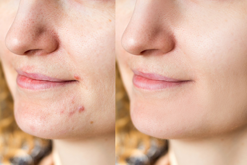 Acne scars and pores. Black spots, wrinkles and skin problems and the use of skin care creams